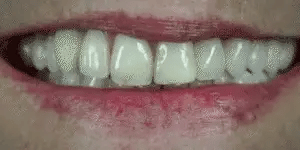 LumaGrin Quick Snap Veneers For Upper And Lower Teeth 2