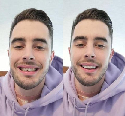 LumaGrin Quick Snap Veneers For Upper And Lower Teeth 4