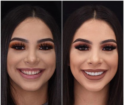 LumaGrin Quick Snap Veneers For Upper And Lower Teeth 5