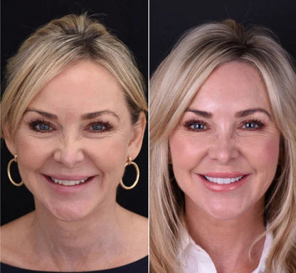 LumaGrin Quick Snap Veneers For Upper And Lower Teeth 6
