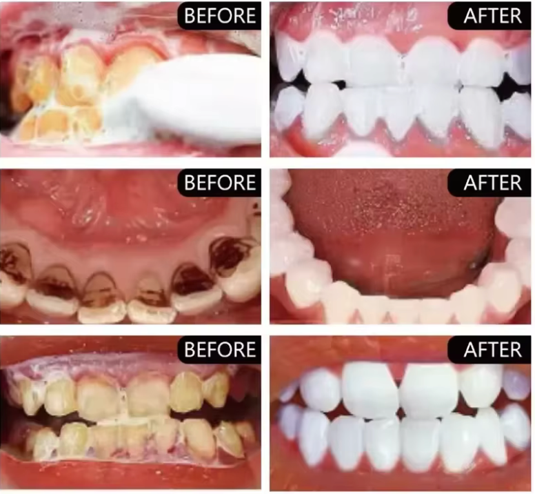 PurelyWHITE | Teeth Brightening Powder | Instant Brightening | For Sensitive Teeth